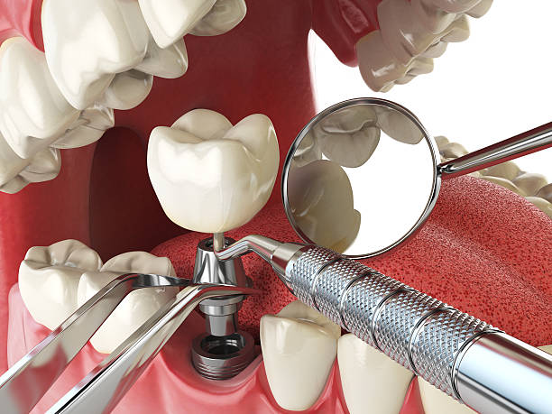 Best Emergency Dental Care for Abscessed Tooth in Glasgow, OR